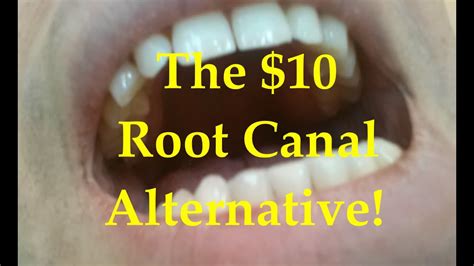 Root Canal Alternatives: Everything You Need to Know 